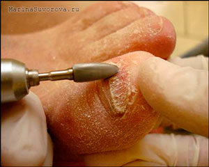 Лечение ногтей в нижнем новгороде