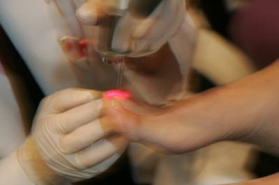 Лечение грибка ногтя лазером нижний новгород