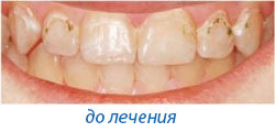 Лечение кариеса нижний новгород