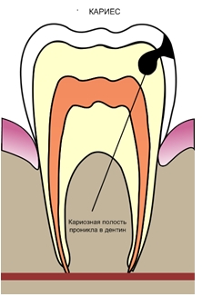 Лечение кариеса нижний новгород